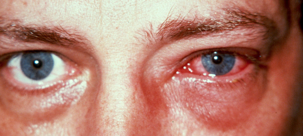 conjuntivitis